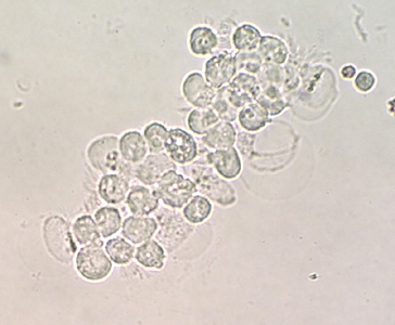 A 72-year-old female with a past medical history of congestive heart failure, diabetes, and hypertension was admitted to a local hospital with complaints of progressive shortness of breath. After admission, she became hypoxic and was intubated and placed on mechanical ventilation support. 
