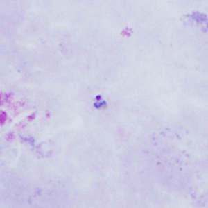 A 31-year-old construction worker, who did some contract work in Ghana for nine months, sought medical attention a few days after his return to the U.S. for recurring fever and chills. 