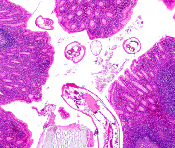 A ten-year-old boy presented at a local hospital with symptoms mimicking an appendicitis. An appendectomy was performed and biopsy specimens were sent to Pathology for routine histologic work-up. 