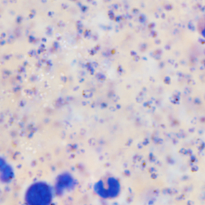 September - 2015 - Case #403 A 25-year-old male presented to the ER with complaints of dizziness, headache, ear pain, fever, chills, and malaise approximately one week after returning from a missionary trip to Ghana.