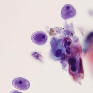 A 31-year-old male presented with recurrent anal warts first noticed the summer of 2014. The warts were biopsied and diagnosed as low grade anal intraepithelial neoplasia (AIN1) in March 2015. Other symptoms included mild discomfort with defecation. 