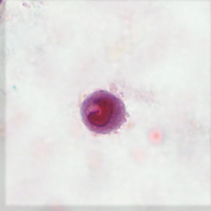 Stool specimens were collected from a 27-year-old girl from Chad as part of a refugee screening program. The stool was collected in 10% formalin and zinc PVA (Zn-PVA) and sent to the county health department for routine ova-and-parasite (O&P) examination. 