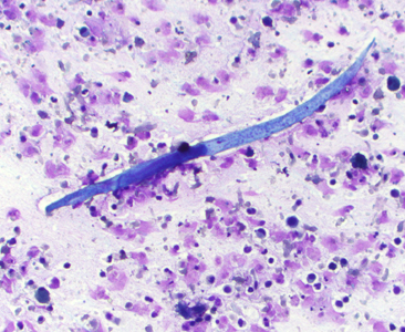 A 50-year-old male originally from Southeast Asia was undergoing chemotherapy for squamous cell carcinoma of the lung. He was admitted one week prior with nausea, vomiting, and confusion. 