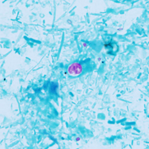 A 42-year-old dairy farmer sought medical attention for watery diarrhea, fever, and nausea that he had been experiencing for about one week. 