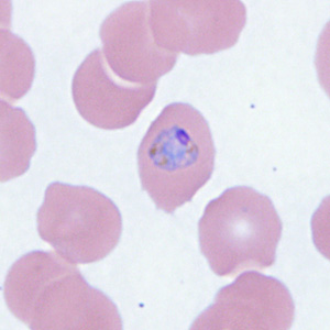 A 22-year-old man, who had traveled to Kenya for a month, developed fever, chills, and general weakness within four days after returning to the U.S. 