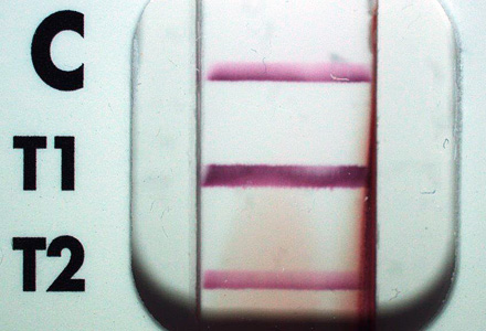 A 20-year-old male from Ghana presented to a hospital with flu-like illness, hepatomegaly, thrombocytopenia, a low absolute lymphocyte count (ALC), an elevated absolute monocyte count (AMC), and lymphocyte reactive forms. 