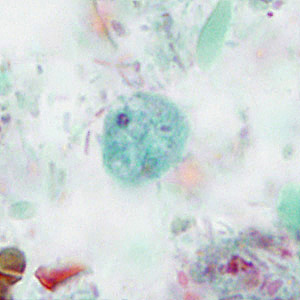 A 7-year-old boy was presented to his health care provider with symptoms of intermittent diarrhea, abdominal pain and loss of appetite. A stool specimen was collected in 10% formalin and zinc PVA (Zn-PVA) for routine ova-and-parasite (O&P) examination. 