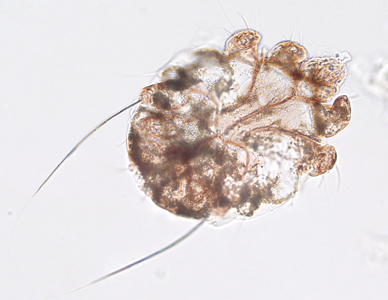 An 81-year-old female developed hyperkeratotic plaques between her fingers and toes while undergoing aggressive chemotherapy for acute myeloid leukemia (AML). Skin scrapings were performed on the plaques and sent to Microbiology for routine work-up. 
