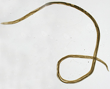 April - 2016 - Case #417 A 27-year-old man had worms excised from his eyelid and chest at a health care facility in Canada. The patient had traveled to Sudan two years earlier, but had not traveled since then.