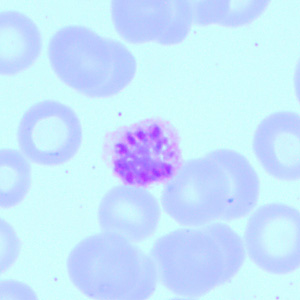 A 34-year-old-woman sought medical assistance at a facility in New Zealand for rigors, fever, and headache. She had been diagnosed with malaria (species not determined) in 2012 in Mozambique and was treated with artesunate. 