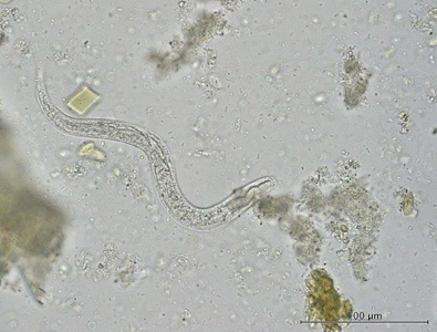 A 62-year-old female from rural Manitoba Province, Canada presented to a health care provider with abdominal pain, diarrhea, and peripheral eosinophilia.  