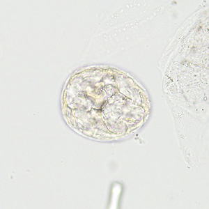 A stool specimen was collected from a 10-year-old boy from Cambodia as part of a refugee screening program. The stool was collected in 10% formalin and sent to the local county health department for routine ova-and-parasite (O&P) examination. 