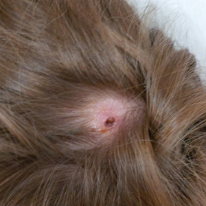 July - 2016 - Case #423 A six-year-old boy from Washington, D.C. presented with a non-migratory furuncle on his scalp several weeks after returning from a trip to Belize (Figures A and B).