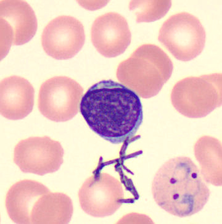 A 22-month-old child presented to the emergency room after 10 days of cyclic fever and chills, decreased PO intake, and seizures. The child had emigrated from a country in the Middle East with her family three months prior. 