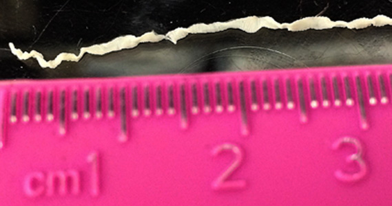 August - 2016 - Case #425 The mother of a four-year-old autistic boy found a worm in her son’s stool while changing his diaper. The family lives on a farm in rural Iowa.