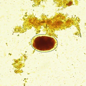 A 38-year-old female refugee from Congo had a routine blood workup and the findings revealed that she had low neutrophil count, low platelet count, and elevated eosinophil count. 
