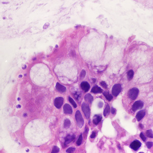 A 27-year-old male with a medical history of AIDS and recent history of opportunistic infections such as Pneumocystis jirovecii pneumonia (PCP) presented with fever, diarrhea, abdominal pain, chest pain and malaise. 