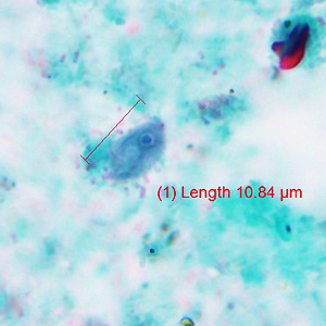A stool specimen was collected from a 76-year-old man as part of a visit to his health care provider. The stool was collected in a single-vial preservative for ova-and-parasite testing. 