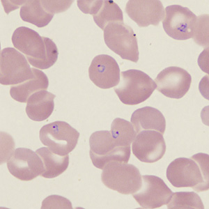 A 62-year-old man from Kenya had been living in rural Connecticut with relatives for 6 months when he developed fever, chills, and fatigue. The family took him to their health care provider for medical attention.