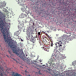 A 61- year-old man presented in 2015 with abdominal pain and was found to have a perforated sigmoid colon. Initial course notable for intra-abdominal collection, associated with the perforation, which was drained. Surgical procedures included sigmoid resection and diverting colostomy.