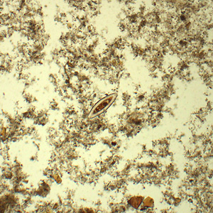A 34-year-old male from Louisiana presented with abdominal discomfort. A stool specimen was collected in 10% formalin and a formalin-ethyl acetate (FEA) concentration was performed. A wet mount smear was prepared from the sediment and examined for ova and parasites (O & P).  