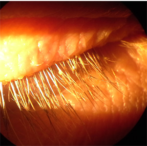 JANUARY - 2017 - Case #435 An adult patient with right eye and eyelid irritation sought medical attention at an eye clinic. Upon examination, living organisms and what appeared to be egg cases were identified on the patient's eyelids and eyelashes.