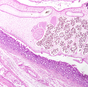 An immigrant from Korea presented with calculi in the intrahepatic biliary passages, cholangitis and early stage cholangiocarcinoma. 