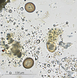 A 36-year-old male immigrant, with an elevated eosinophil count, was suspected of being infected with pinworms and was administered a pinworm paddle test. 