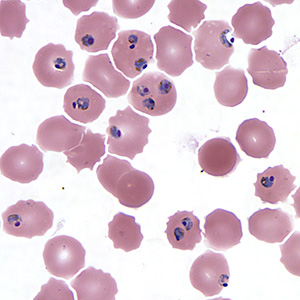 A 29-year-old male immigrant from Nigeria presented to an emergency room with fever, splenomegaly, jaundice, and neurologic changes. 