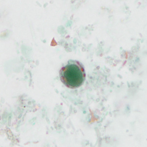 Stool specimens were collected from an asymptomatic 10-year-old boy from Panama as part of a refugee screening program. The stool was collected in 10% formalin and zinc PVA (Zn-PVA) and sent to the county health department for routine ova-and-parasite (O&P) examination.