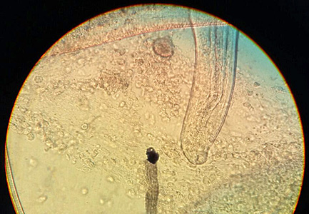 APRIL - 2017 - Case #441 A patient, who lives in a rural region in South America, presented with bloody diarrhea and remembers having eaten undercooked pork. The attending physician submitted images to the DPDx Team of a roundworm he observed during a colonoscopy.