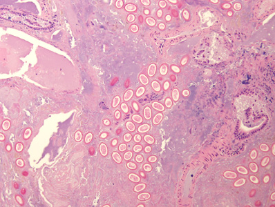A 6-year-old child from a community in rural southeastern United States presented with severe upper right abdominal pain, fever, chills, decreased appetite and weight loss. The child expired 2 weeks after being admitted for symptoms that included hepatitis. 