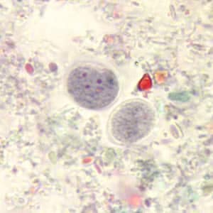Enana_cyst_tric.jpg Figure A
