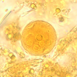 Ecoli_cyst_wtmt4.jpg Figure E: Cyst of <em>E. coli</em> in a concentrated wet mount stained with iodine. Five nuclei are visible in this focal plane.
