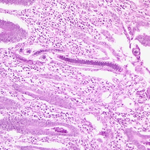 C.philippinensis_HE1.jpg Figure C: Longitudinal section of an adult <em>C. philippinensis</em> from an intestinal biopsy specimen, stained with H&E.