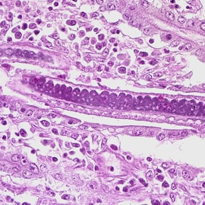 C_philippinensis_HE2.jpg Figure D: Higher magnification of Figure C, showing stichocytes within the adult worm.
