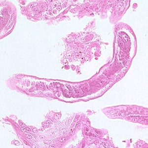 C_philippinensis_tissue6.jpg Figure A: Longitudinal section of an adult of <em>C. philippinensis</em> from an intestinal biopsy specimen stained with hematoxylin and eosin (H&E).