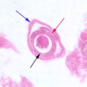 C_philippinensis_tissue_4.jpg Figure E: Cross-section of a gravid adult female <em>C. philippinensis</em> from an intestinal biopsy specimen, stained with H&E. Shown in this figure are a bacillary band (blue arrow), the intestine (red arrow) and uterus containing an egg in cross-section (black arrow).