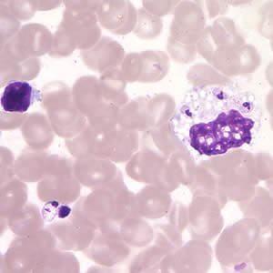 Figure D: <em>Leishmania (Viannia)</em> panamensis amastigotes in a Giemsa-stained tissue scraping.