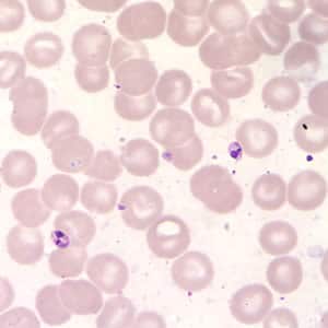 Figure B: <em>Leishmania (Viannia)</em> panamensis amastigotes in a Giemsa-stained tissue scraping. Identification to the species level is not possible based on morphology and other diagnostic techniques such isoenzyme assay or PCR are needed.