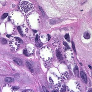 Figure A: Amastigotes of <em>Leishmania</em> sp. in a biopsy specimen from a skin lesion, stained with hematoxylin and eosin (H&E).