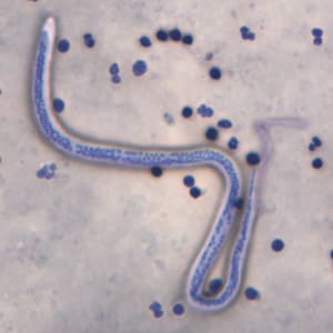 W_bancrofti_ORa.jpg Figure A: Microfilaria of <em>W. bancrofti</em> in a thick blood smear stained with Giemsa. Image courtesy of the Oregon State Public Health Laboratory.