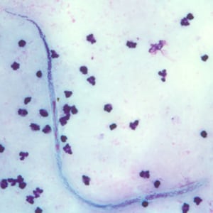 W_bancrofti_whole_BAM1.jpg Figure C: Microfilaria of <em>W. bancrofti</em> in a thick blood smear, stained with Giemsa.