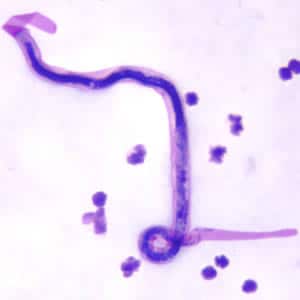Brugia_malayi.jpg Figure A: Microfilaria of <em>B. malayi</em> in a thick blood smear, stained with Giemsa.