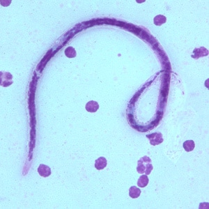 B_timori_Giemsa_500x_BAM2.jpg Figure B: Microfilaria of <em>B. timori</em> in a thick blood smear from a patient from Indonesia, stained with Giemsa and captured at 500x oil magnification. Image from a specimen courtesy of Dr. Thomas C. Orihel, Tulane University, New Orleans, LA.