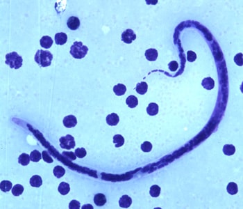 B_timori_Giemsa_500x_BAM3.jpg Figure C: Microfilaria of <em>B. timori</em> in a thick blood smear from a patient from Indonesia, stained with Giemsa and captured at 500x oil magnification. Image from a specimen courtesy of Dr. Thomas C. Orihel, Tulane University, New Orleans, LA.