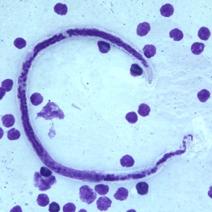 B_timori_Giemsa_500x_BAM4.jpg Figure D: Microfilaria of <em>B. timori</em> in a thick blood smear from a patient from Indonesia, stained with Giemsa and captured at 500x oil magnification. Image from a specimen courtesy of Dr. Thomas C. Orihel, Tulane University, New Orleans, LA.