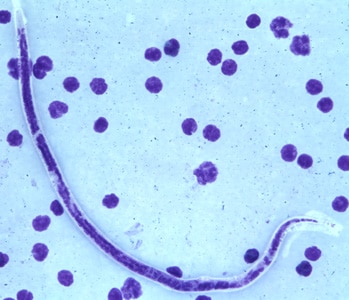 B_timori_Giemsa_500x_BAM5.jpg Figure E: Microfilaria of <em>B. timori</em> in a thick blood smear from a patient from Indonesia, stained with Giemsa and captured at 500x oil magnification. Image from a specimen courtesy of Dr. Thomas C. Orihel, Tulane University, New Orleans, LA.