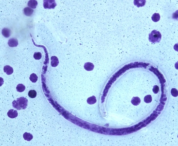 B_timori_Giemsa_500x_BAM6.jpg Figure F: Microfilaria of <em>B. timori</em> in a thick blood smear from a patient from Indonesia, stained with Giemsa and captured at 500x oil magnification. Image from a specimen courtesy of Dr. Thomas C. Orihel, Tulane University, New Orleans, LA.