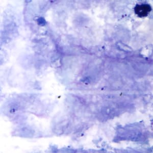 Pf_rings_thickF.jpg Figure F: Rings of <em>P. falciparum</em> in a thick blood smear.